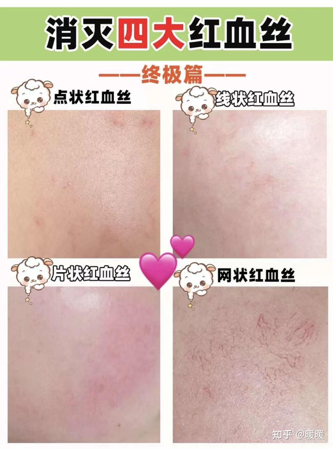 激光去红血丝价格?美容激光设备分析?