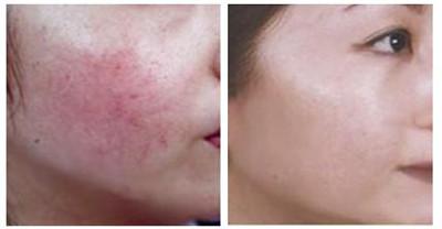 烟台曙光SOGOOD任细妹做光子去红血丝咋样